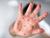 آخر تحديث.. وزارة الصحة انتقال جدرى القرود بين البشر محدود ولا يوجد حالات فى مصر