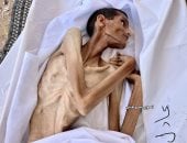 شاب فلسطينى يموت جوعا فى مستشفى الشفاء الطبى بغزة صورة